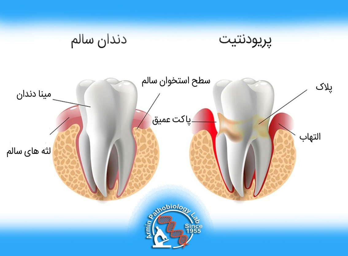 بارداری و پریودنتیت: