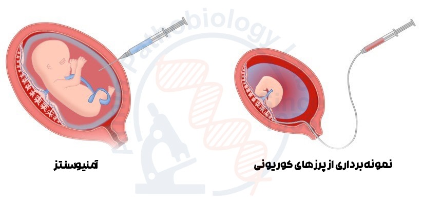 نمونه‌برداری از پرزهای کوریونی (CVS) و آمنیوسنتز | آزمایشگاه آرمین