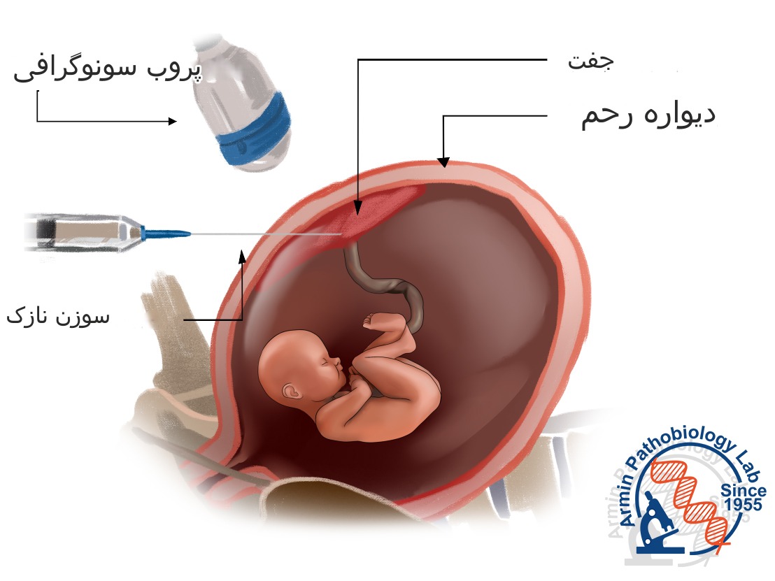 نمونه برداری از پرزهای کوریونی (CVS) | آزمایشگاه آرمین