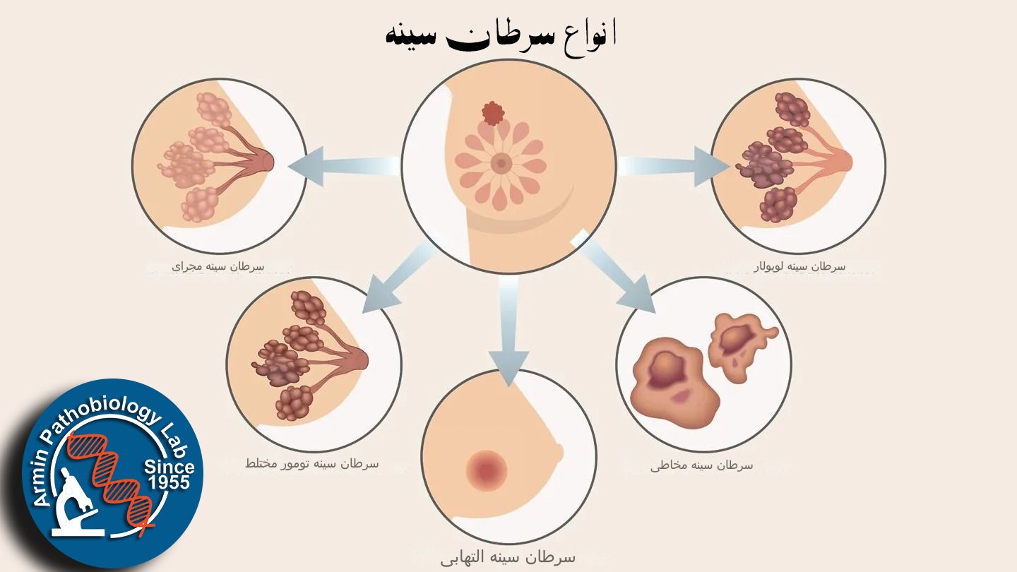 سرطان سینه