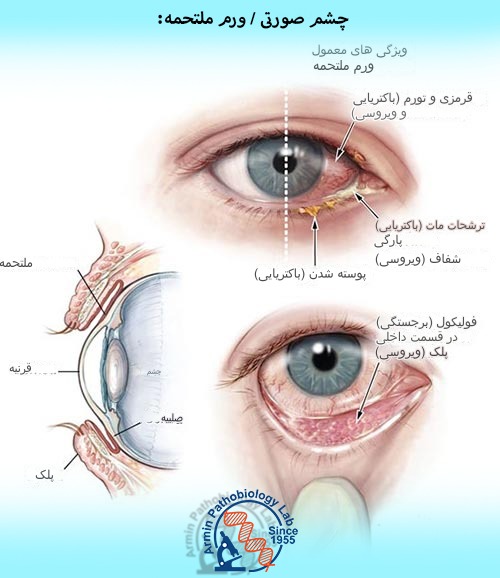 چشم صورتی / ورم ملتحمه | آزمایشگاه آرمین