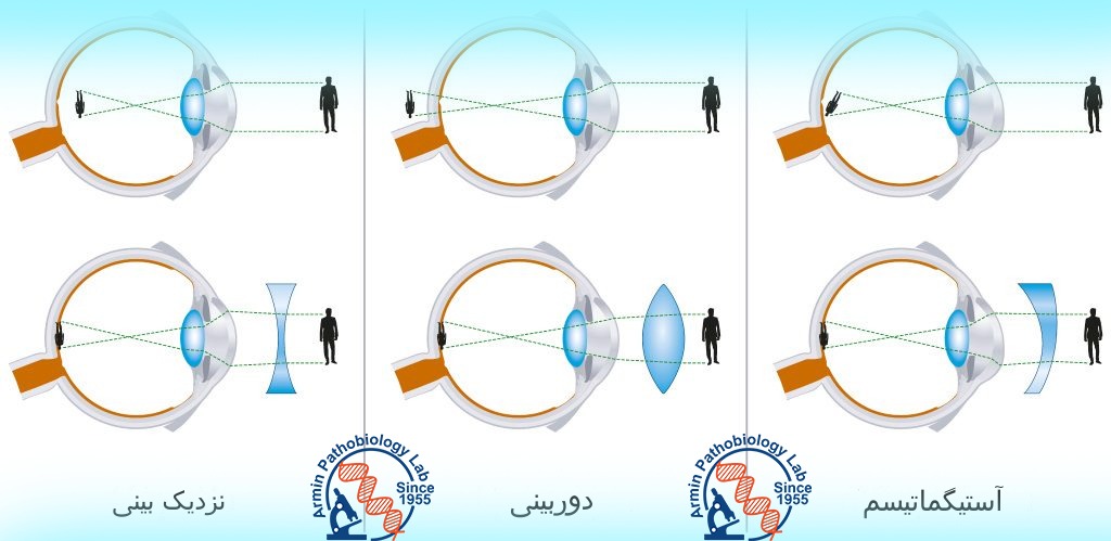 نزدیک بینی، دوربینی و آستیگماتیسم | آزمایشگاه آرمین