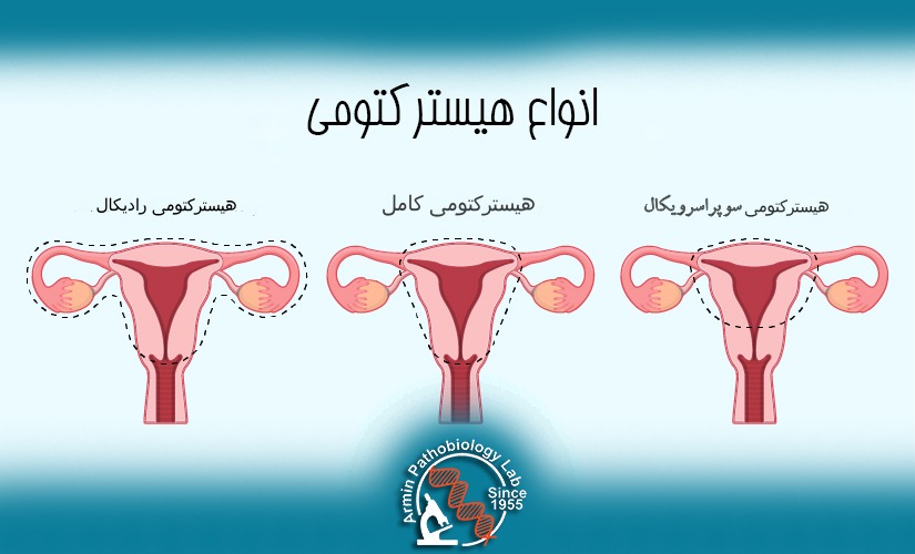 مزایای هیسترکتومی چیست؟ انواع هیسترکتومی