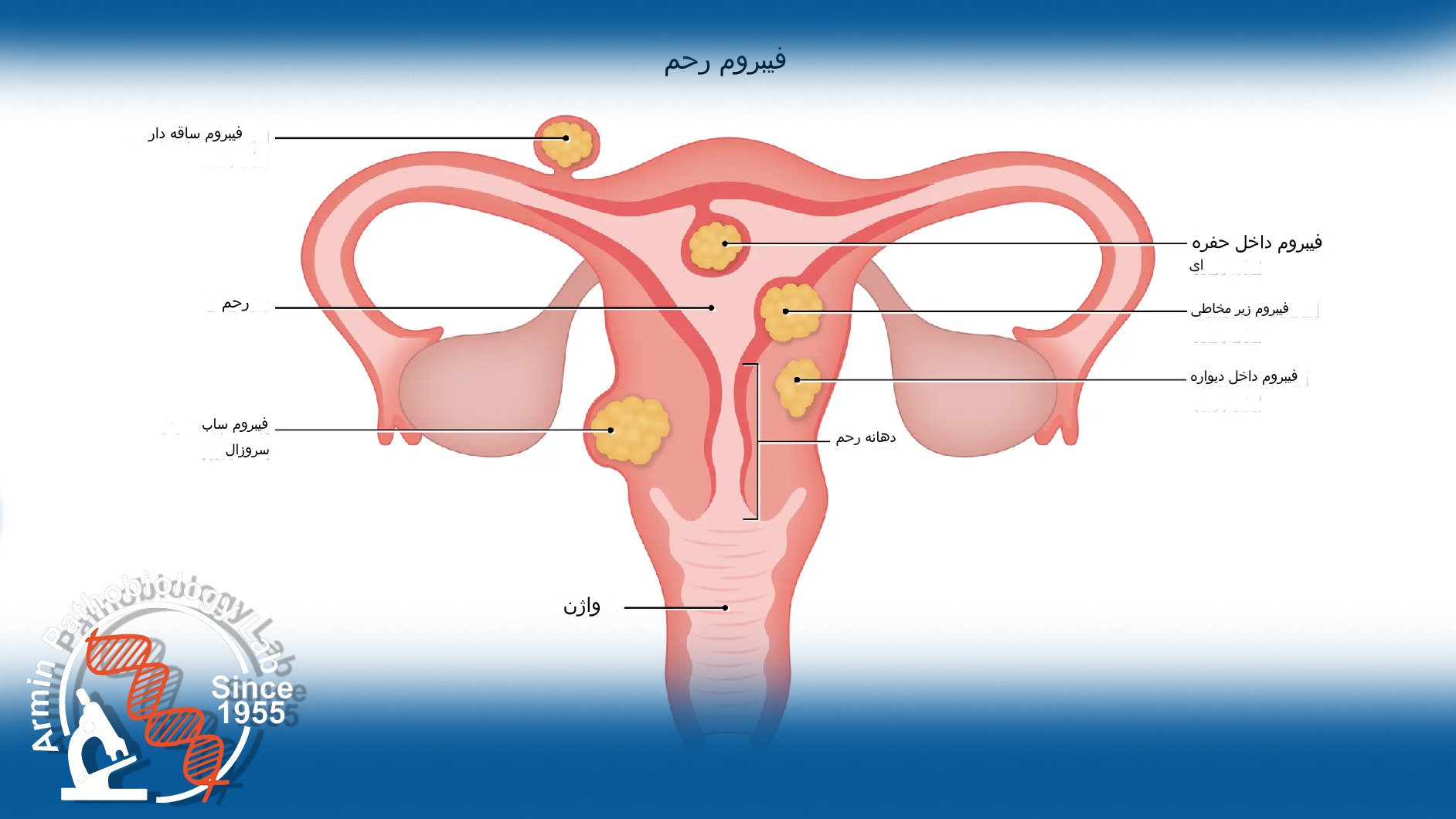 دلیل اصلی هیسترکتومی