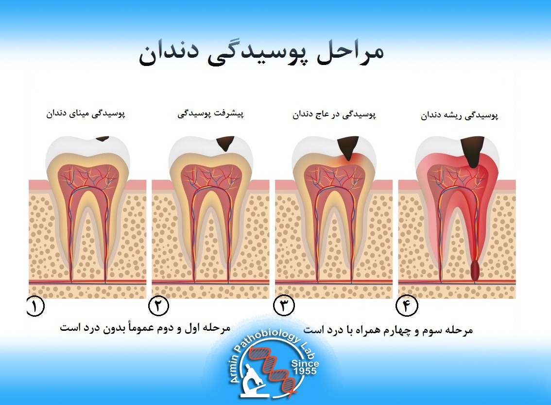 پوسیدگی دندان در بارداری