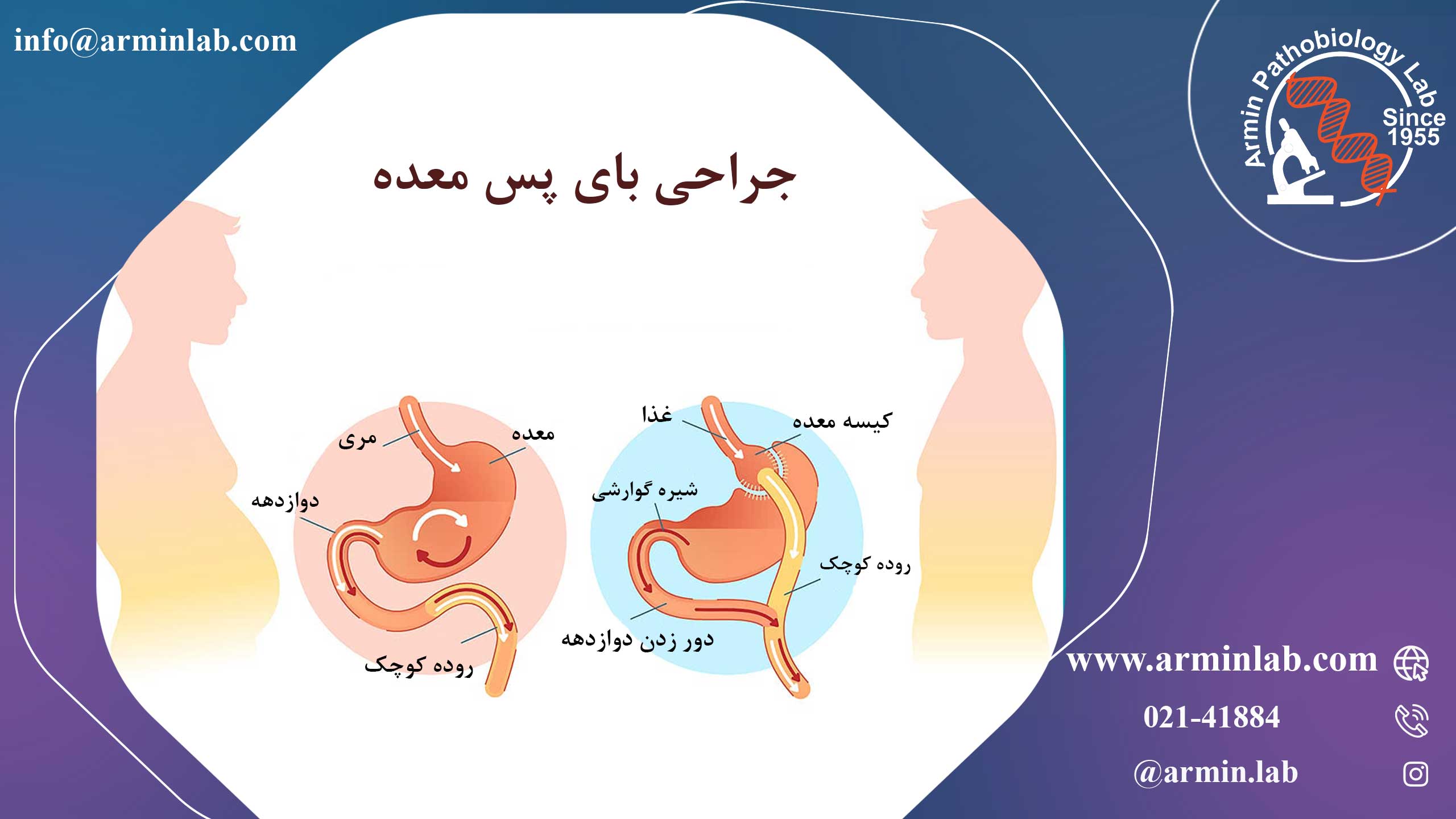 جراحی بای پس معده