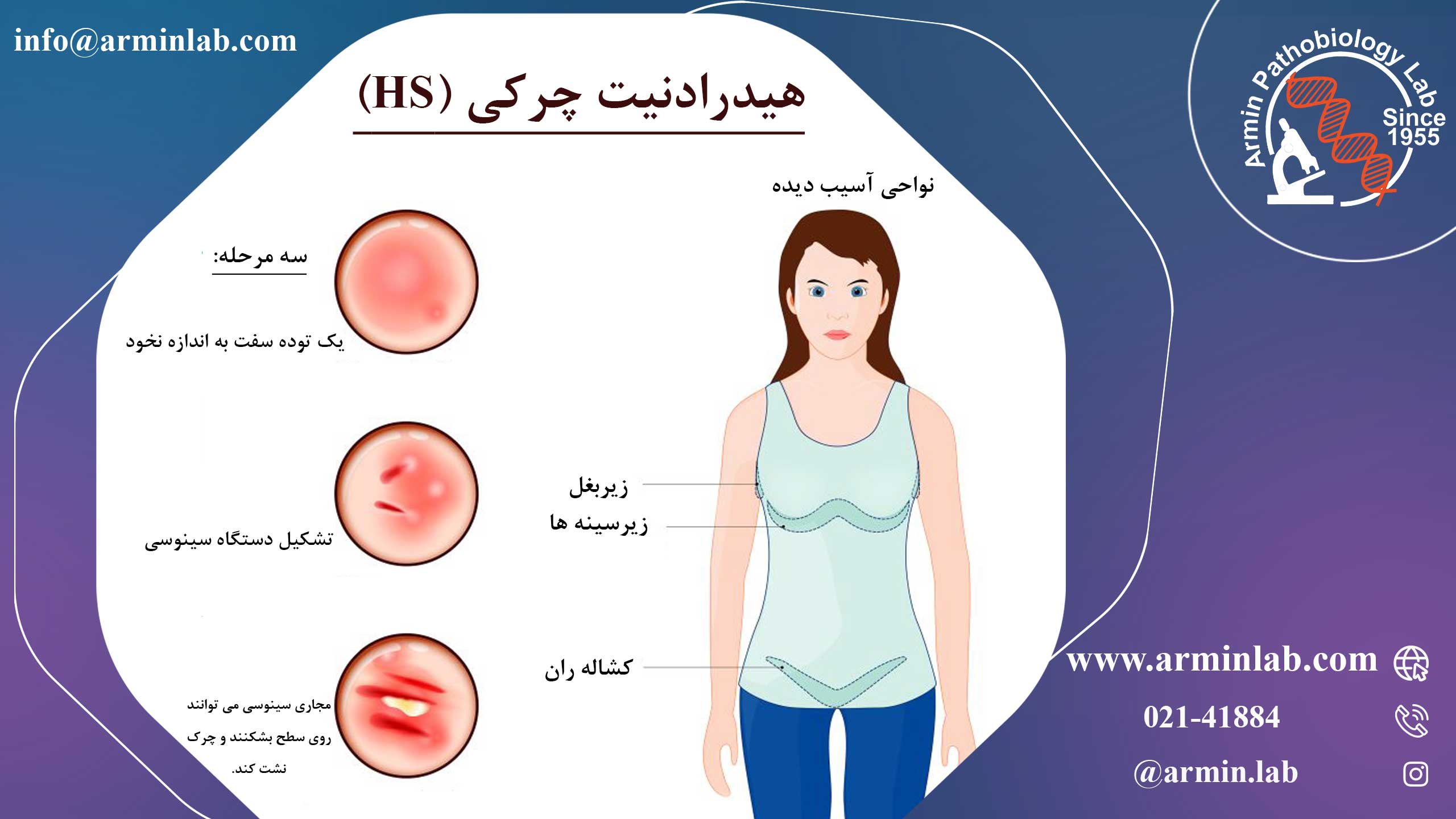 هیدرادنیت چرکی (HS) در بارداری