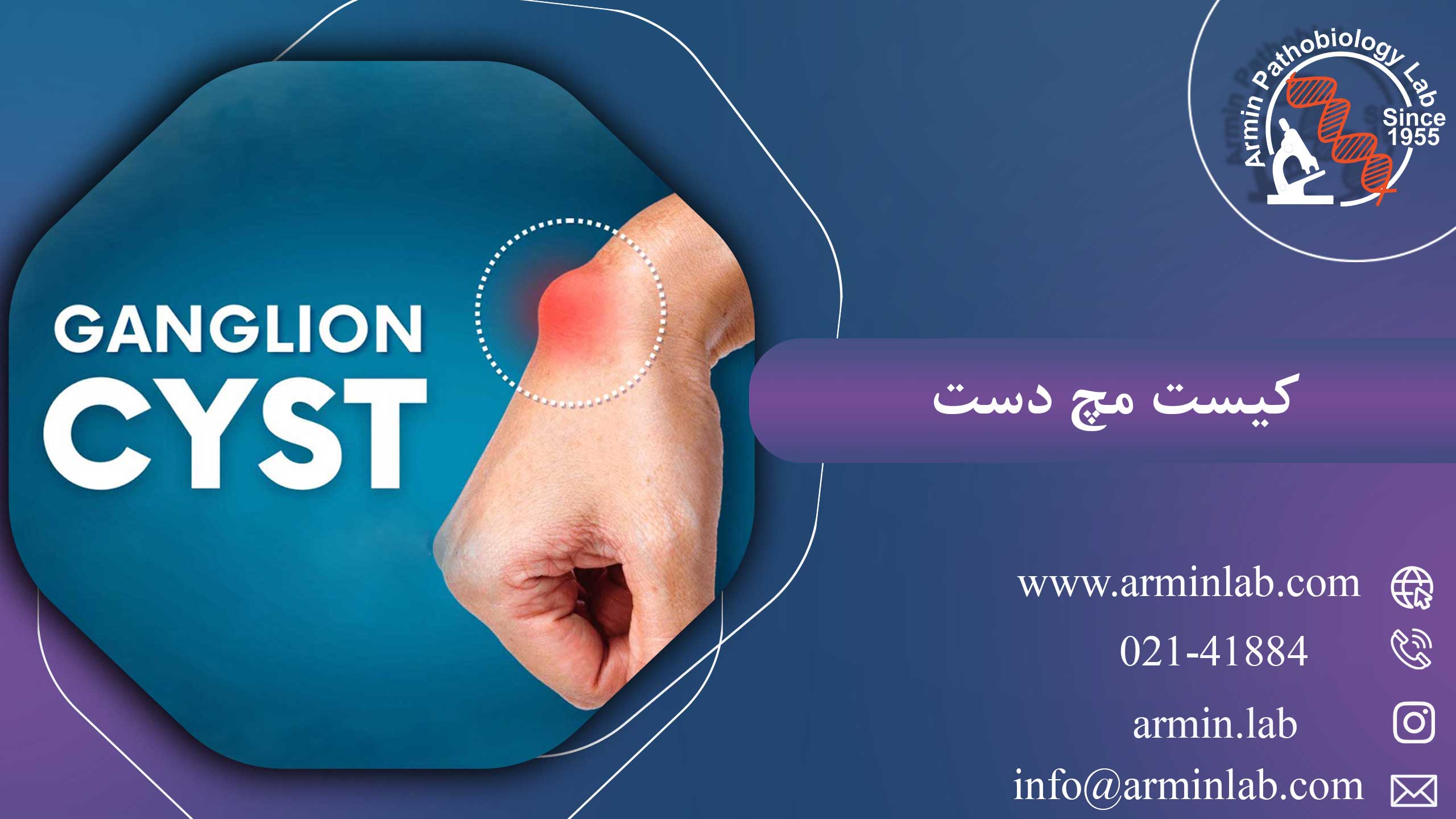 کیست مچ دست