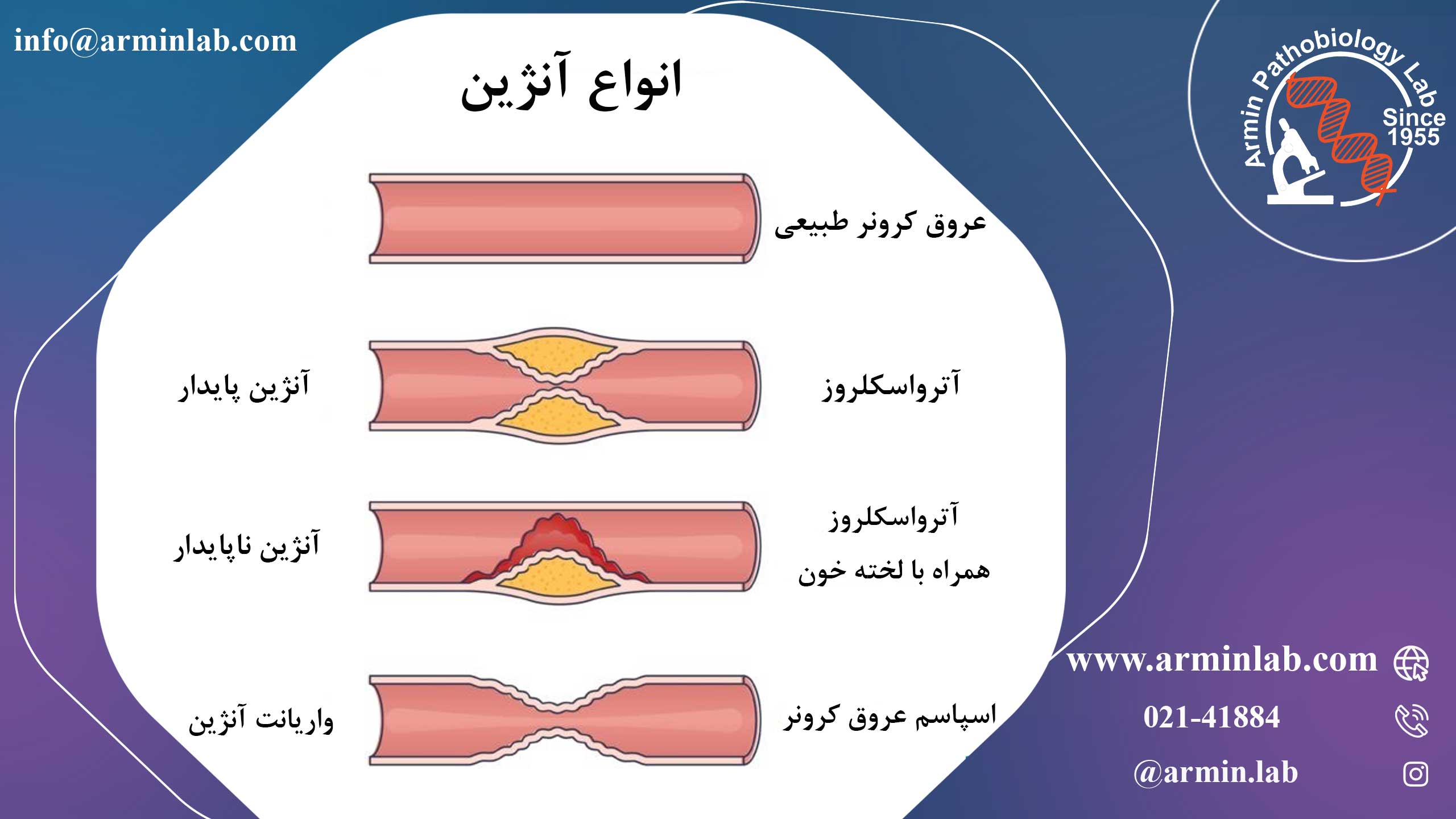 آنژین (درد قفسه سینه)  