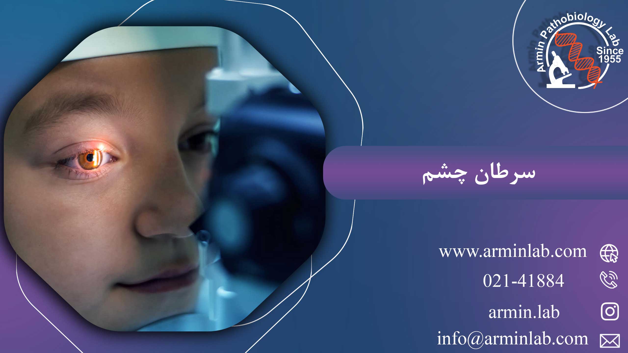سرطان-چشم-arminlab1 سرطان چشم