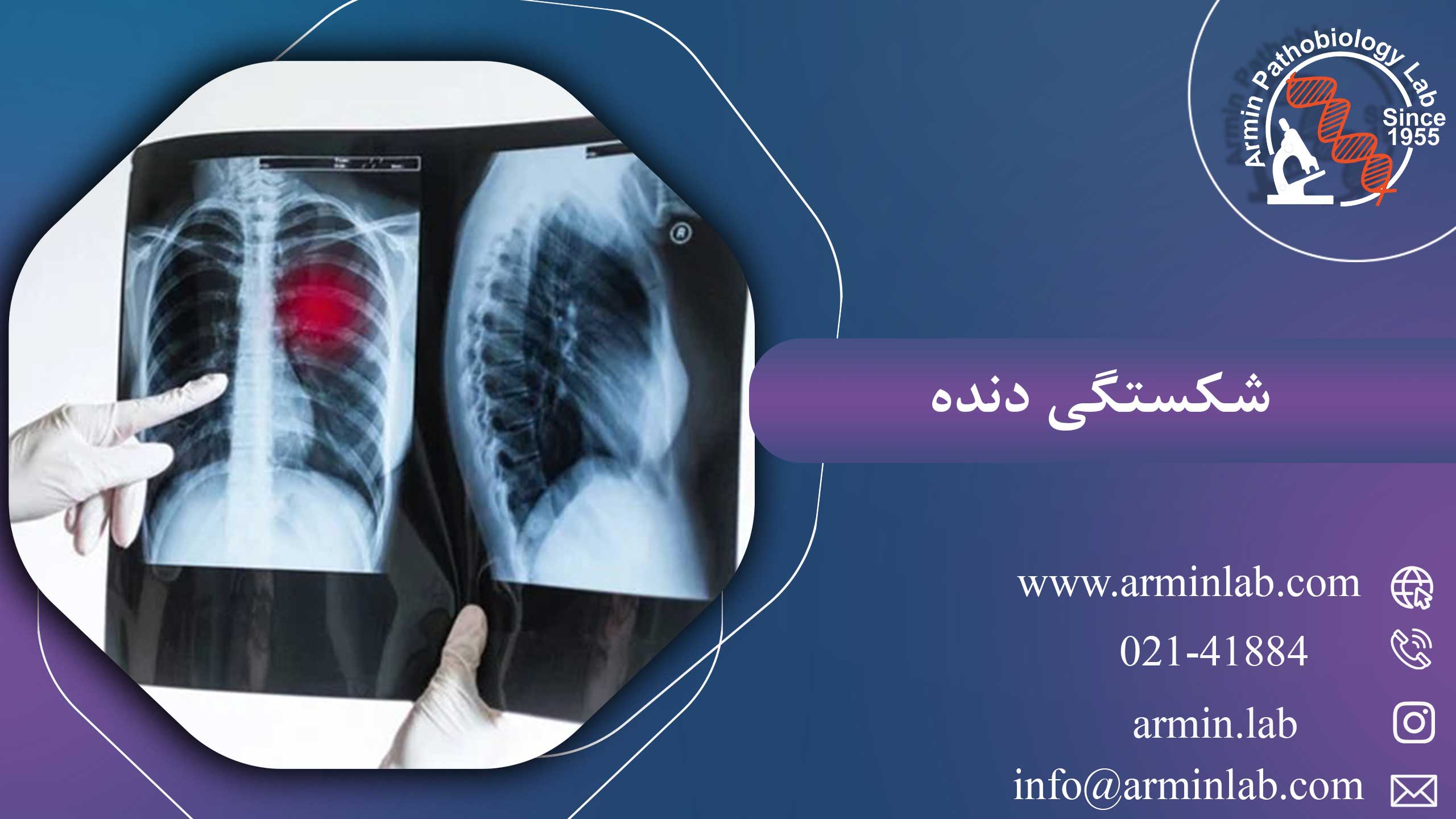 شکستگی-دندهarminlab1 شکستگی دنده