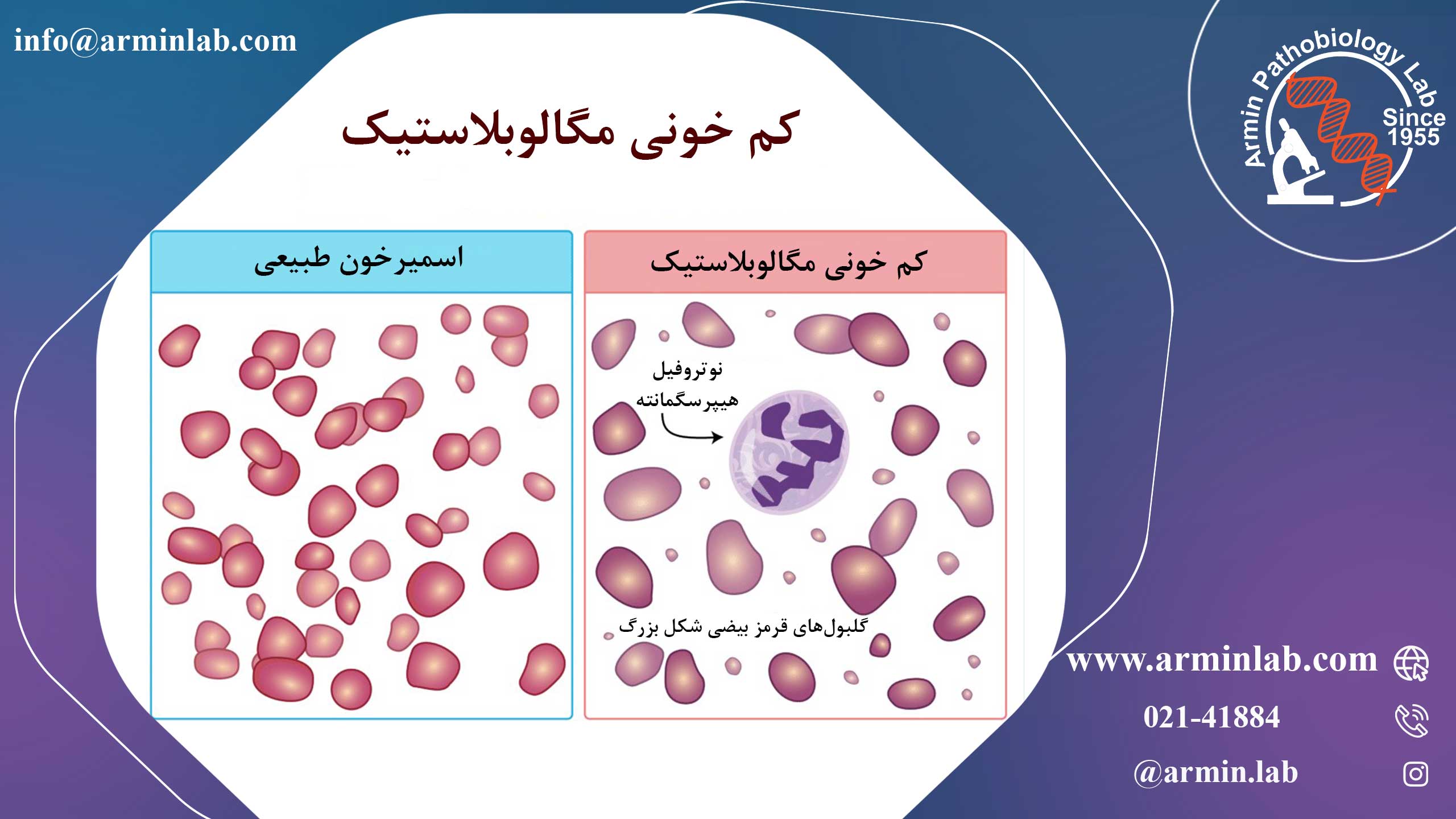 کم خونی مگالوبلاستیک