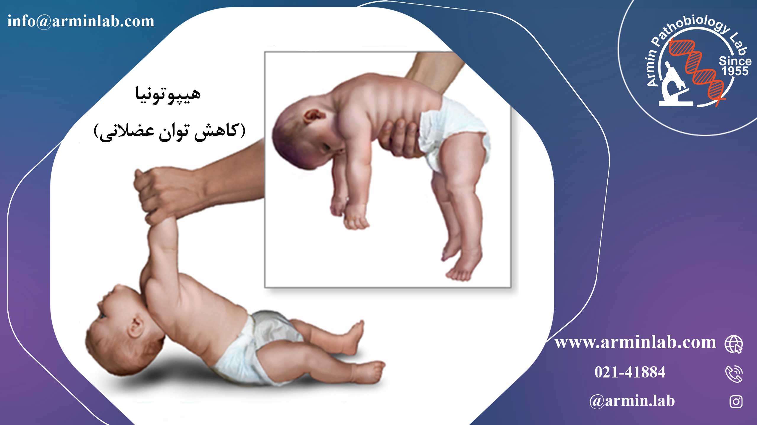 بیماری منکس ( Menkes disease ) 