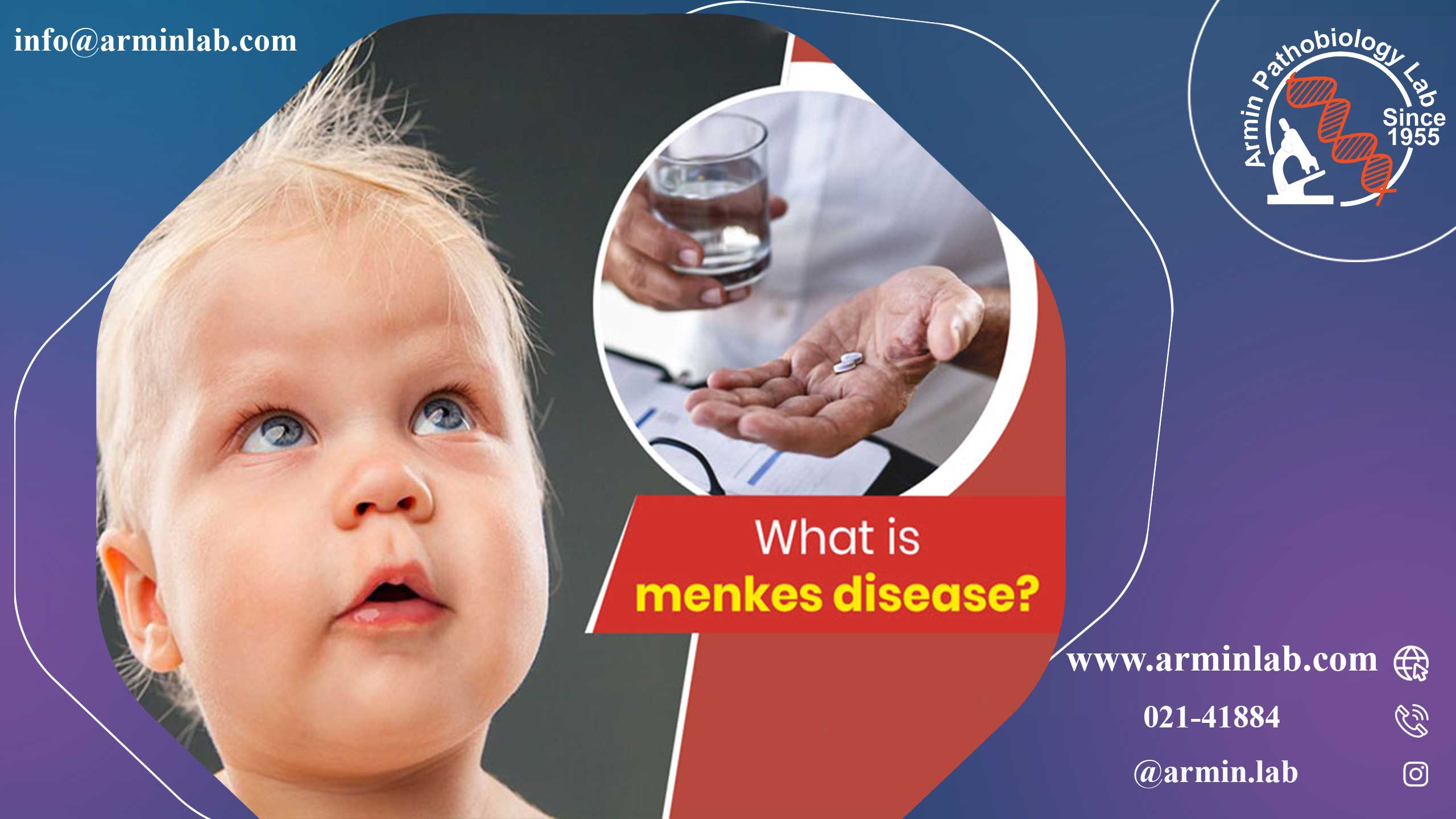 بیماری منکس ( Menkes disease ) 