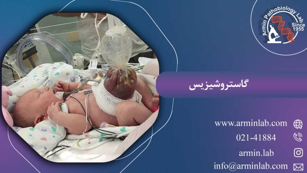 گاستروشیزیس