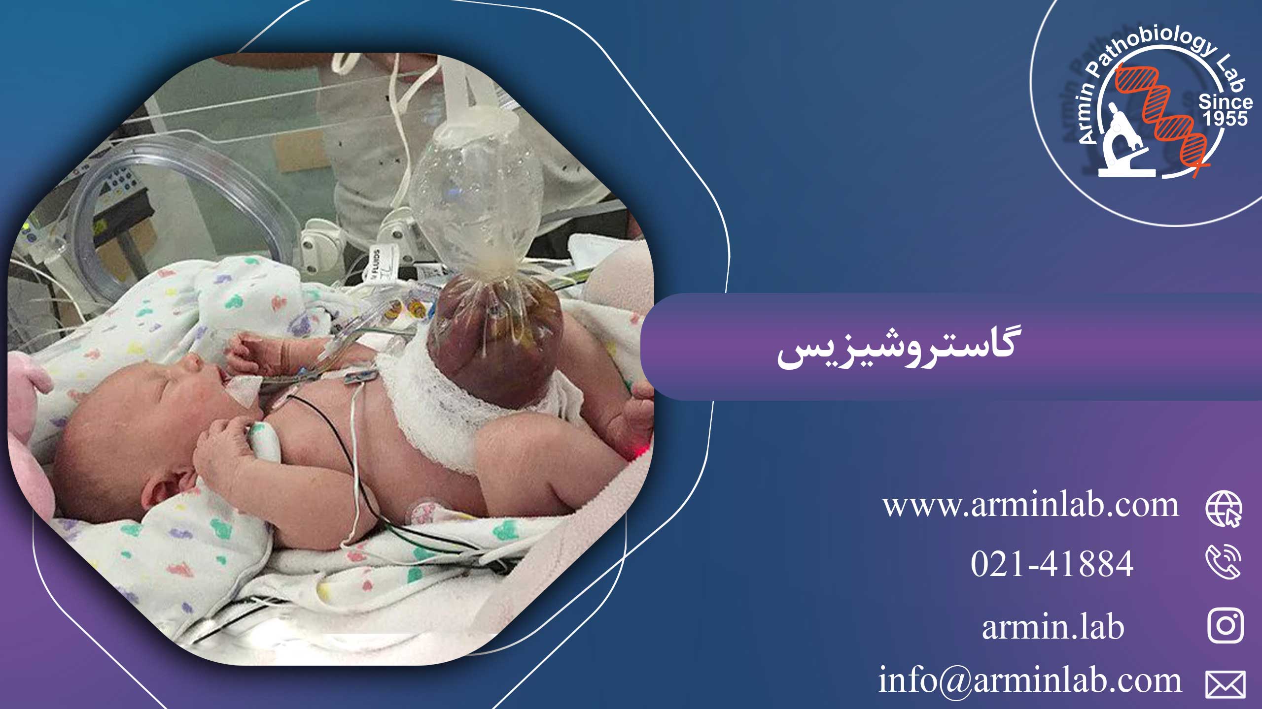 گاستروشیزیس