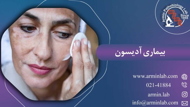 بیماری آدیسون