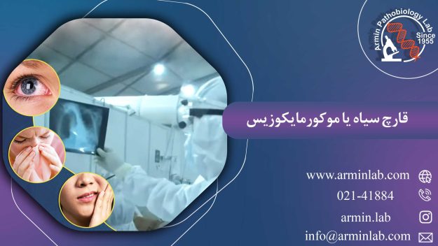 قارچ سیاه یا موکورمایکوزیس