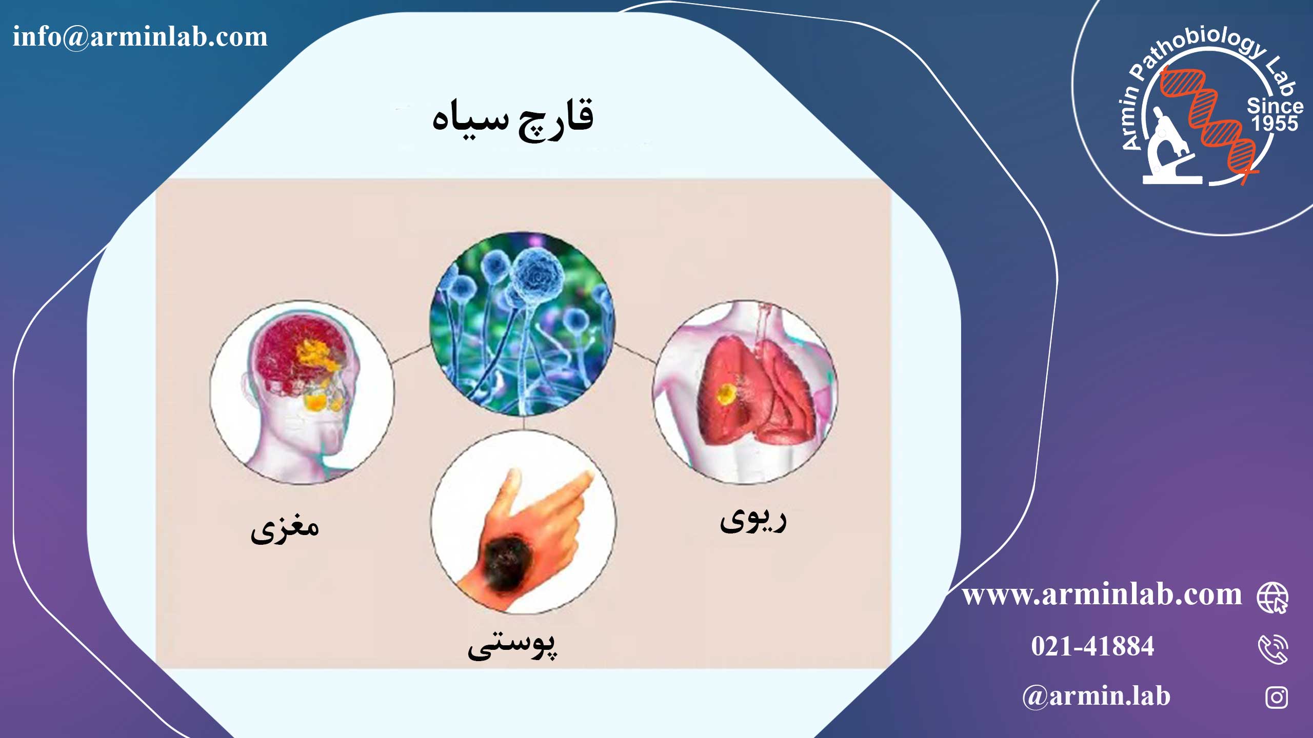 قارچ سیاه یا موکورمایکوزیس 