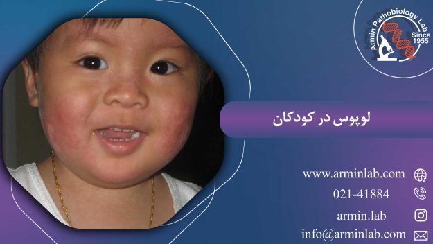 لوپوس در کودکان