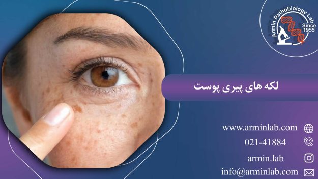 لکه های پیری پوست
