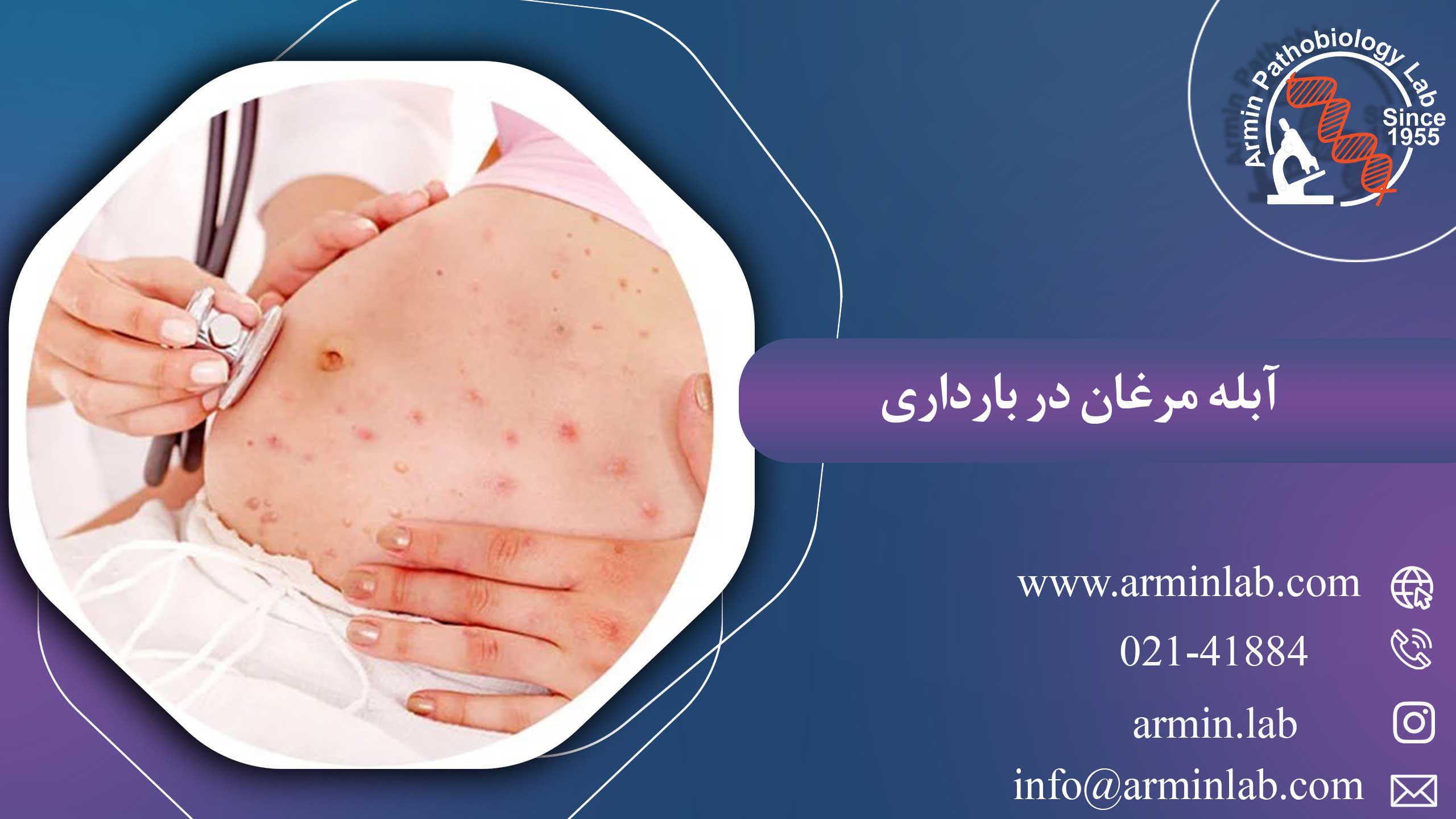 آبله مرغان در بارداری