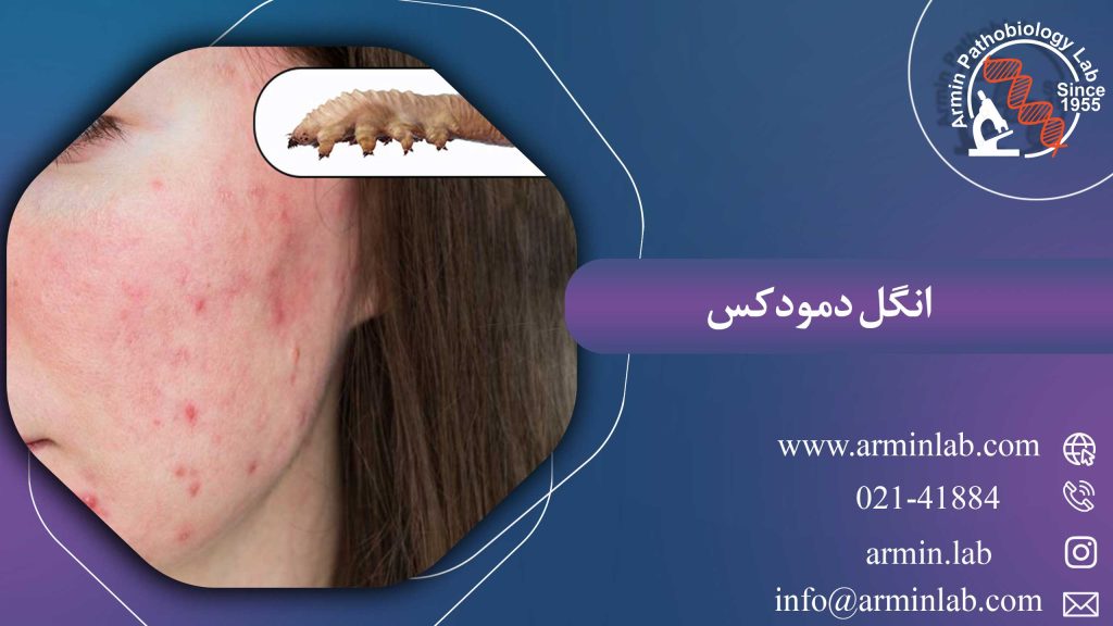 انگل دمودکس