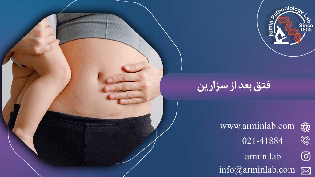 فتق بعد از سزارین