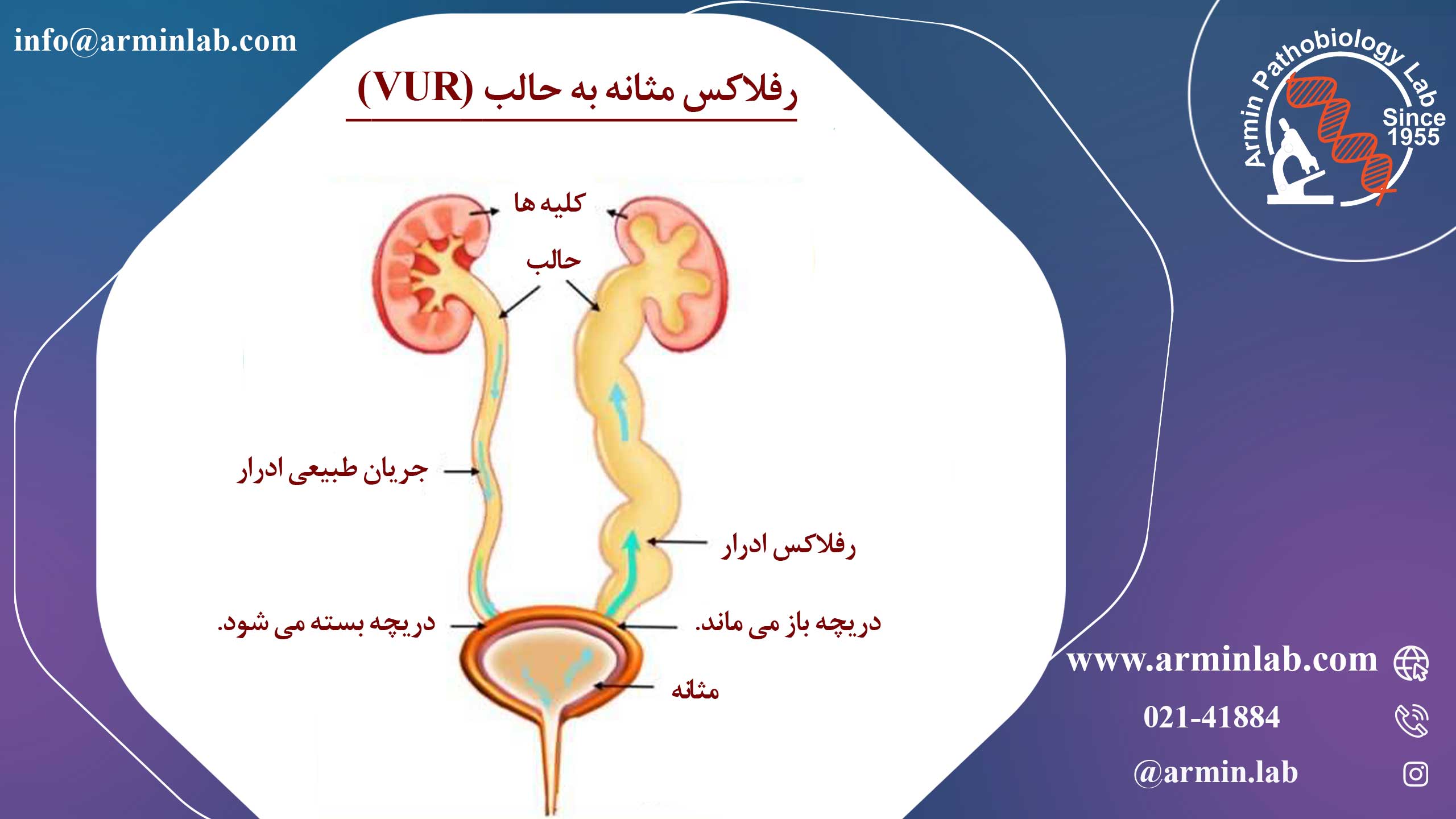 رفلاکس یا بازگشت ادرار از مثانه به حالب (VUR)