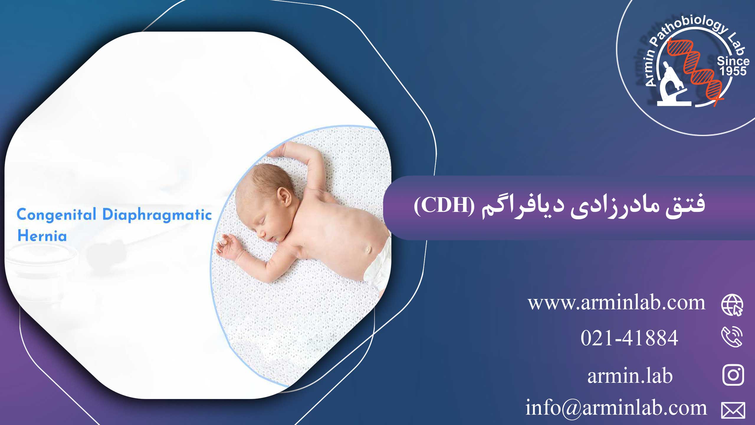 فتق دیافراگم مادرزادی (CDH)