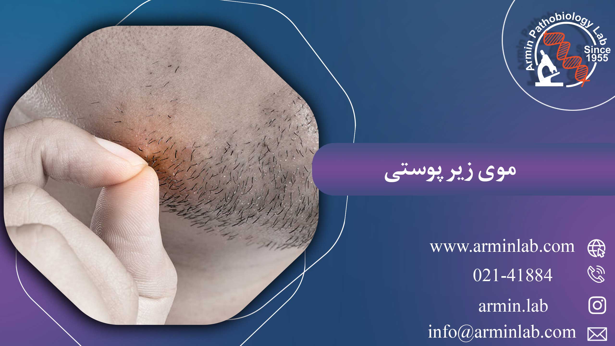 موی زیر پوستی