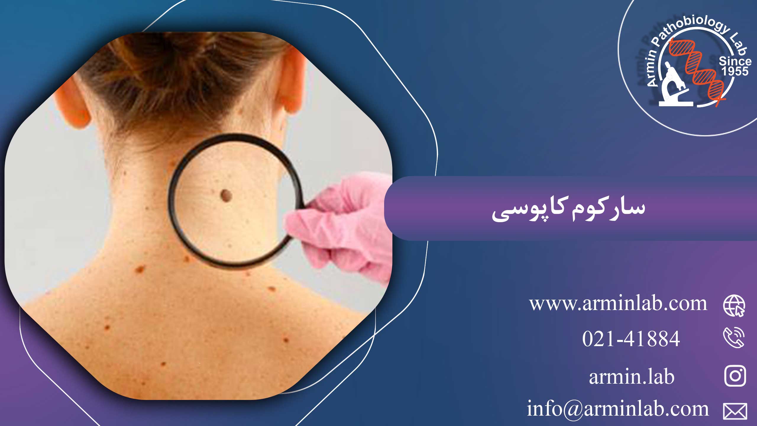 سارکوم کاپوسی