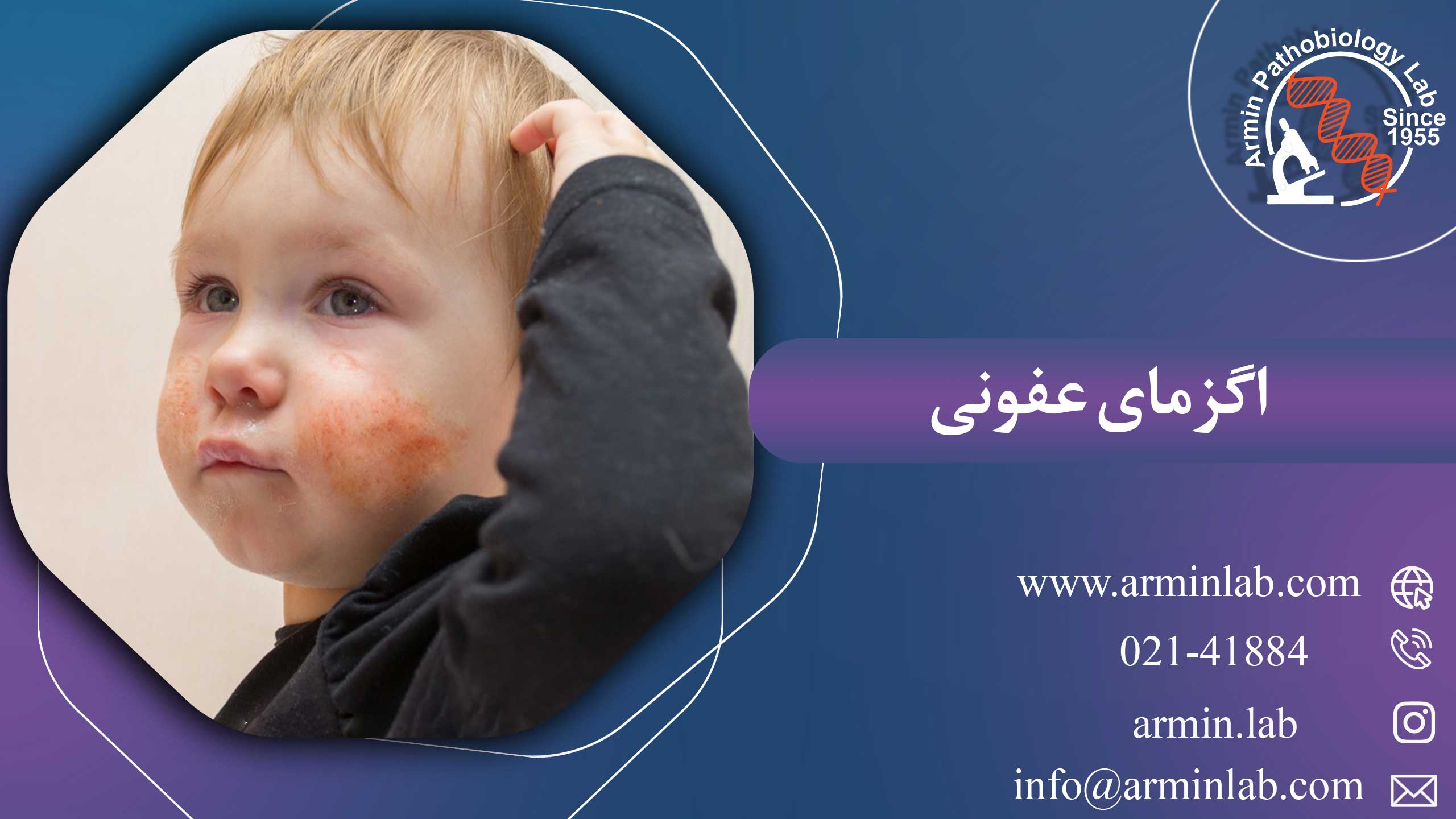 اگزمای عفونی