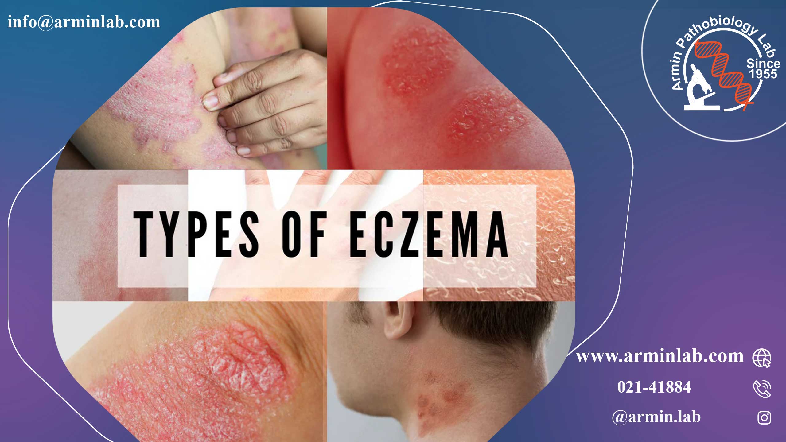 اگزمای عفونی