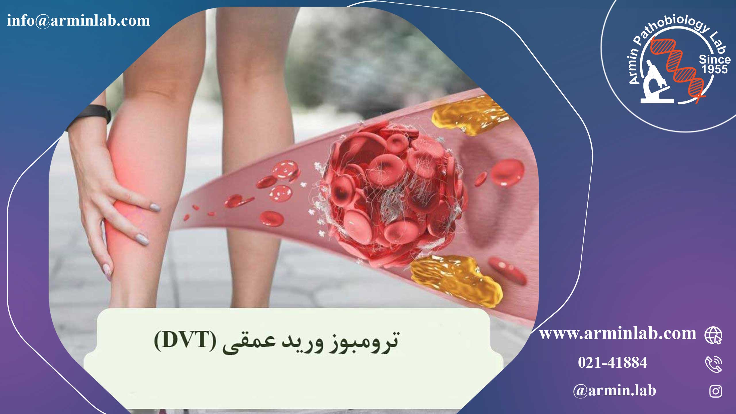 ترومبوز ورید عمقی (DVT) در بارداری  