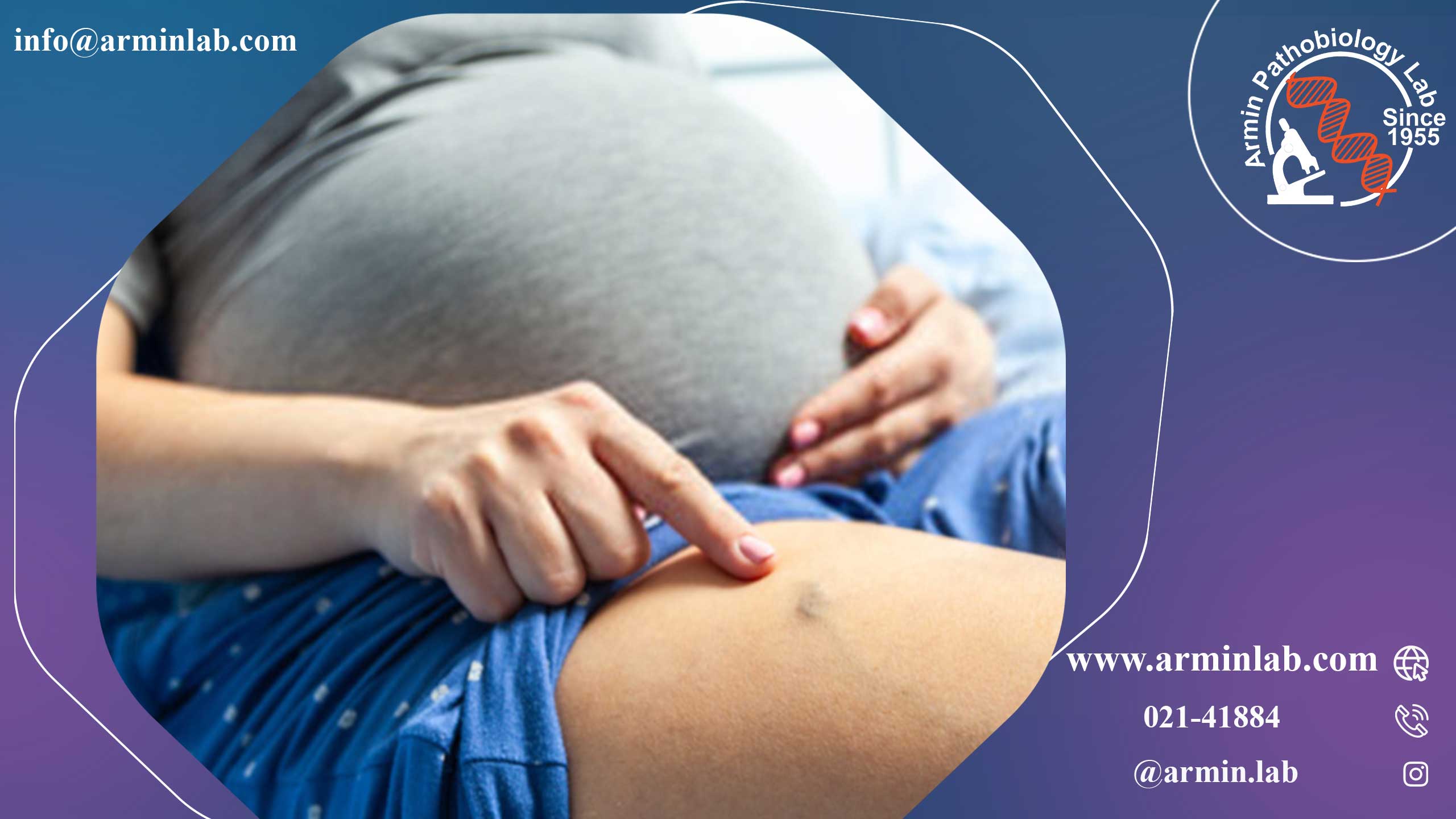 ترومبوز ورید عمقی (DVT) در بارداری  