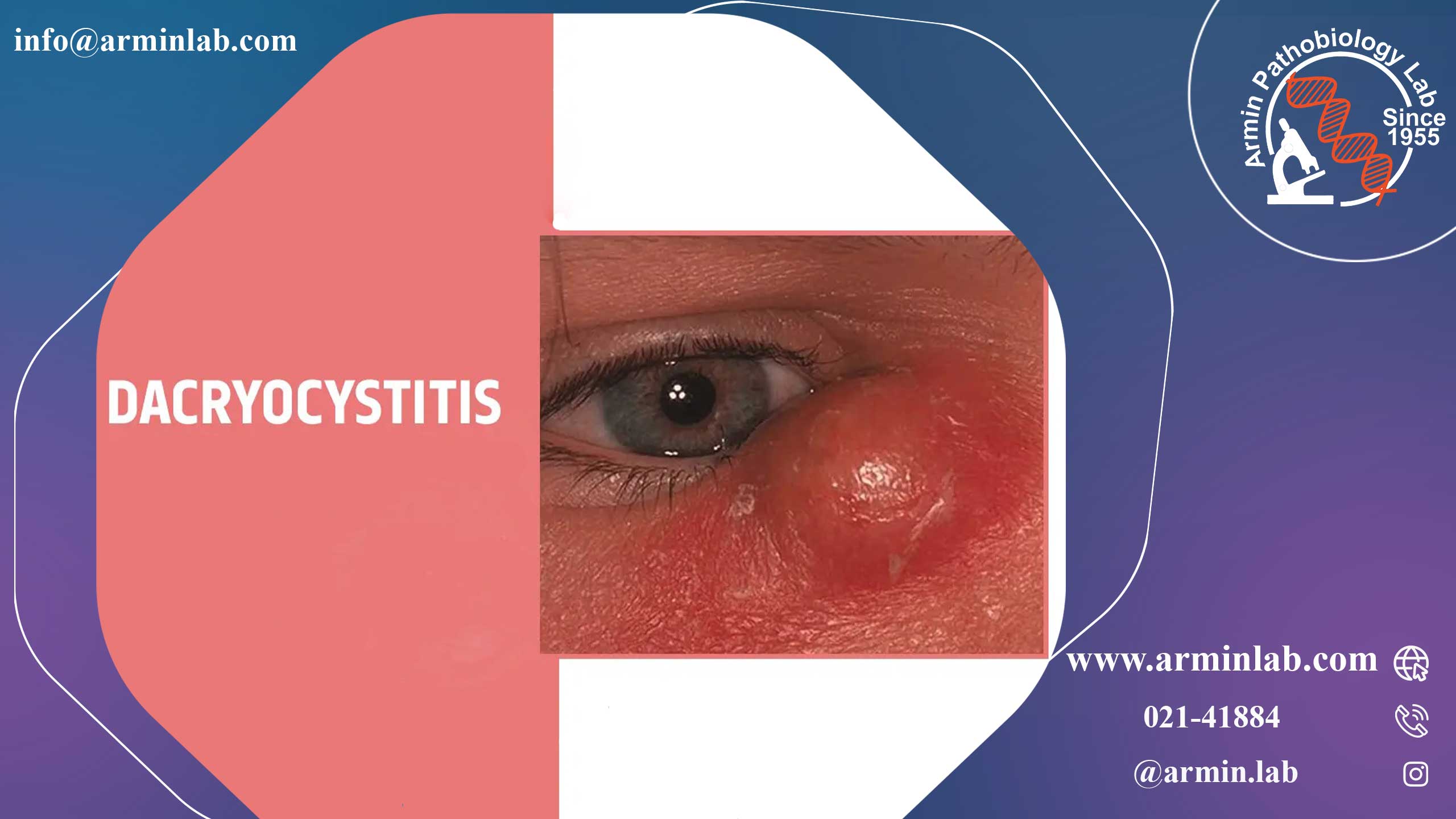 داکریوسیستیت