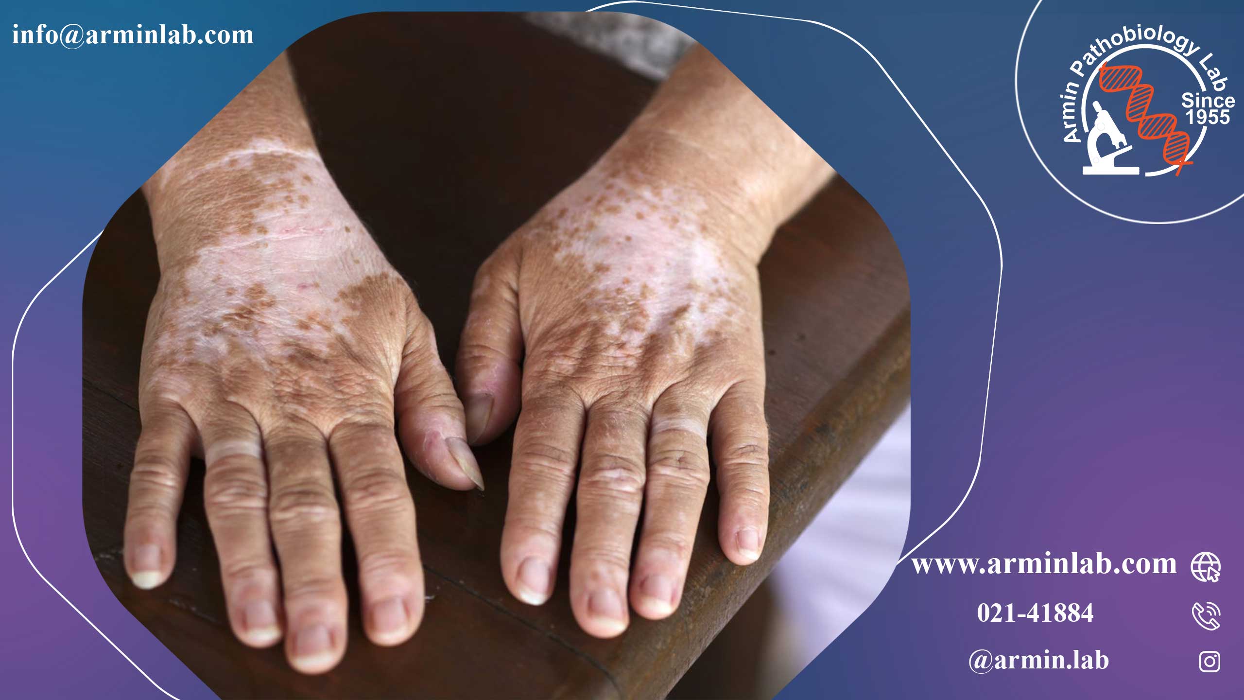 سندرم واردنبرگ 