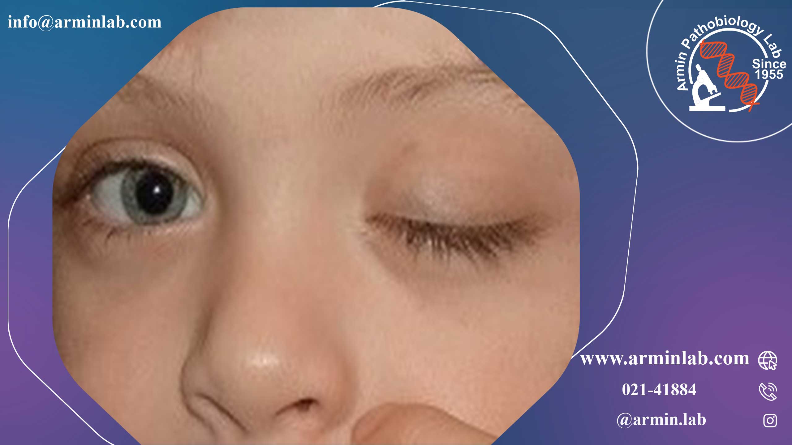 عصب حرکتی چشم (CN III)