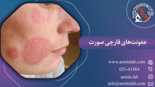 عفونت‌های قارچی صورت