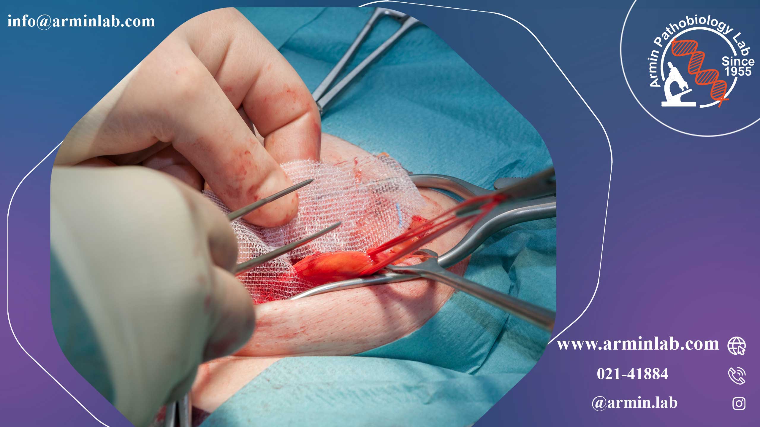 فتق کشاله ران