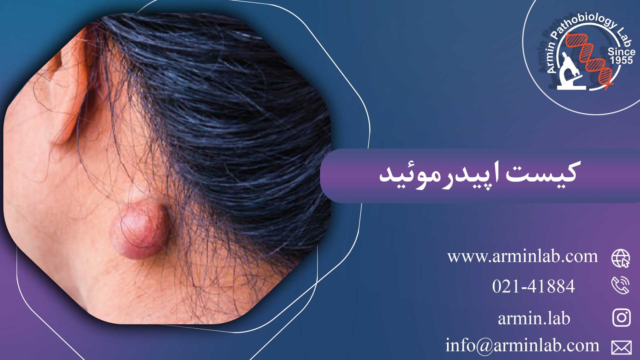 کیست اپیدرموئید