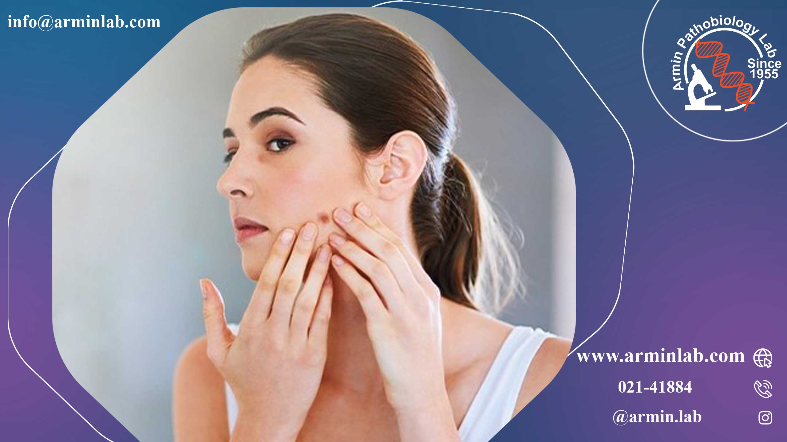 کیست اپیدرموئید 