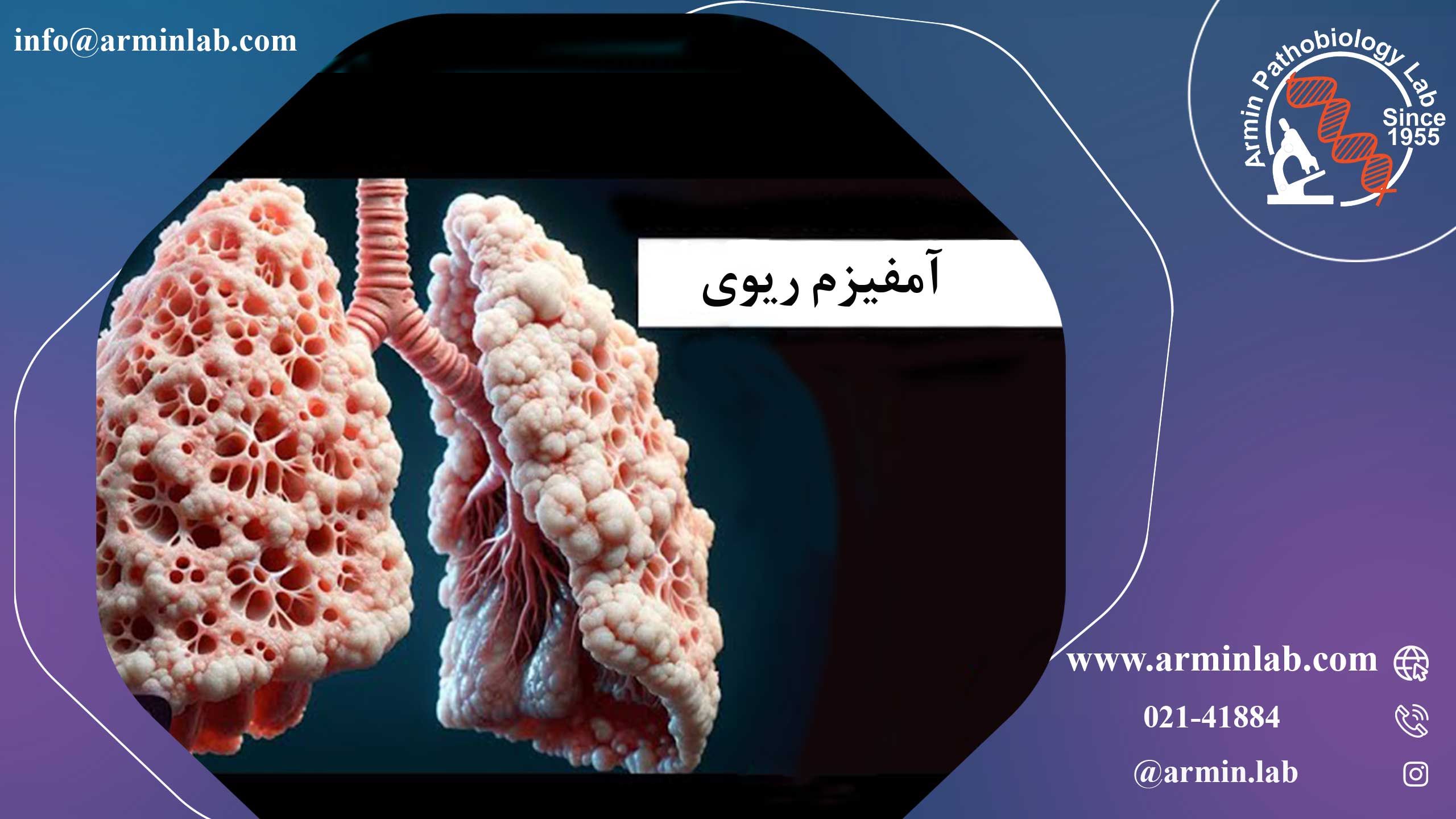 آمفیزم ریوی