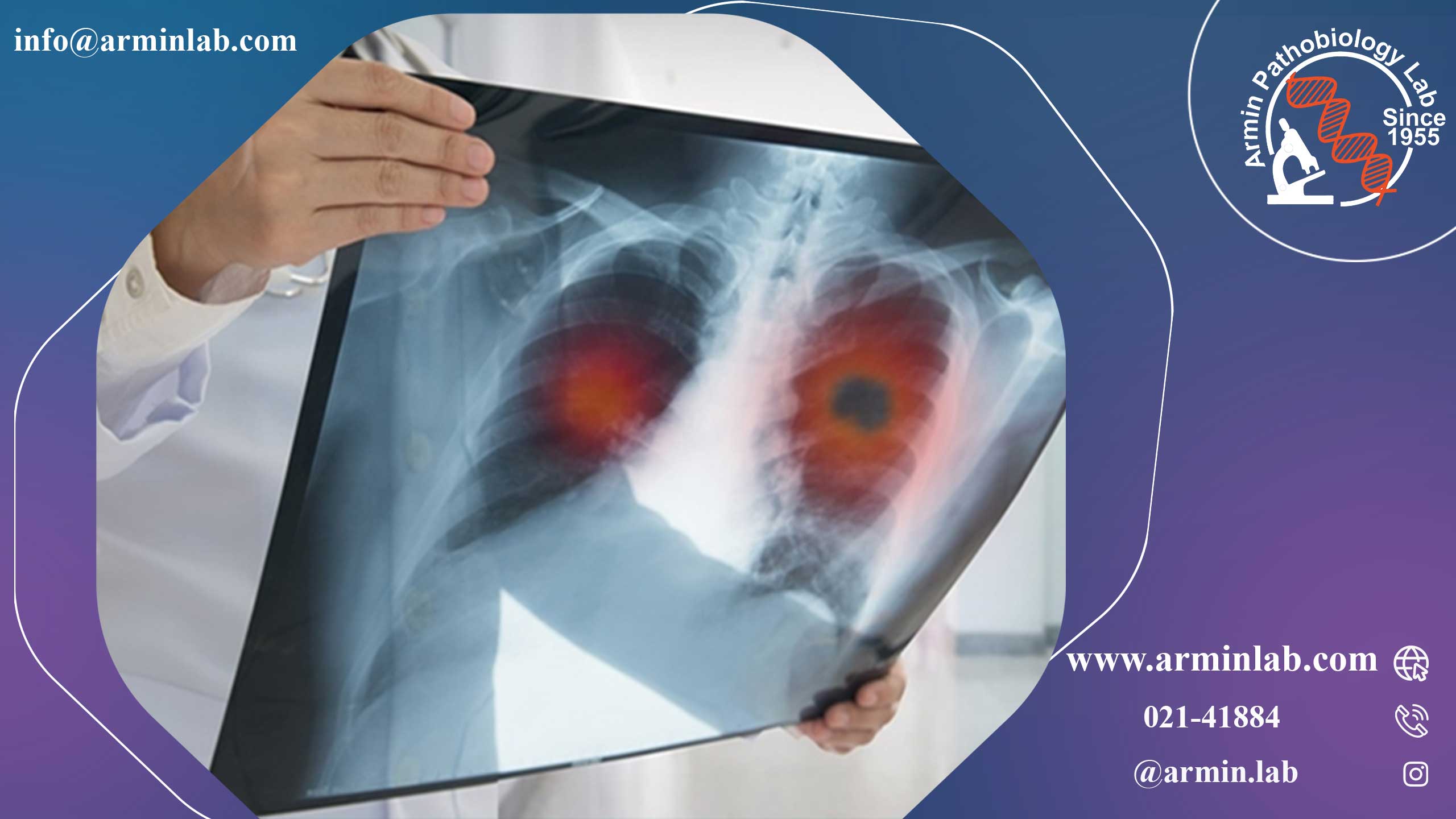 آمفیزم ریوی