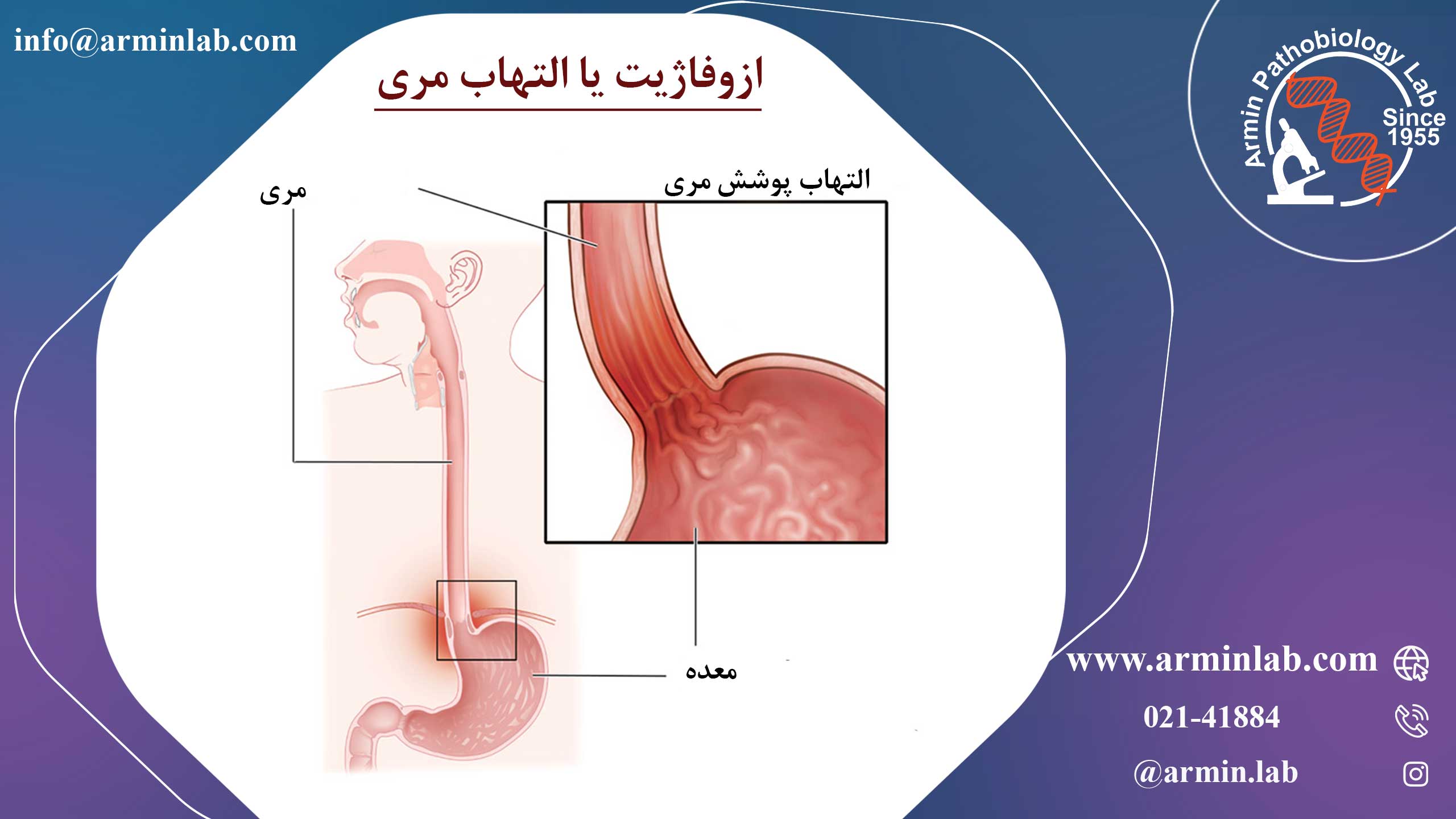 ازوفاژیت یا التهاب مری