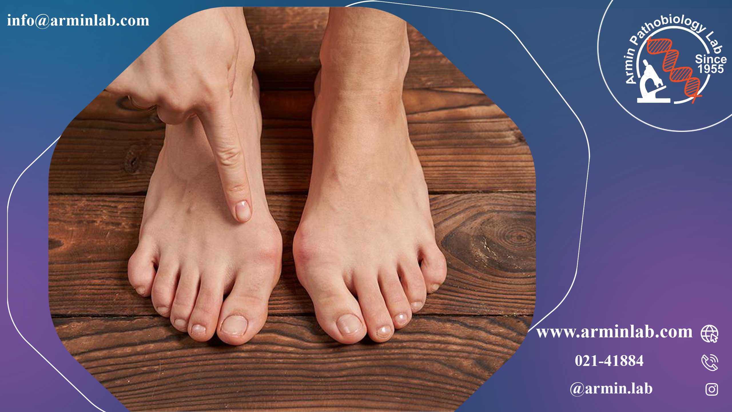 انحراف شست پا هالوکس والگوس (بونیون‌ها)