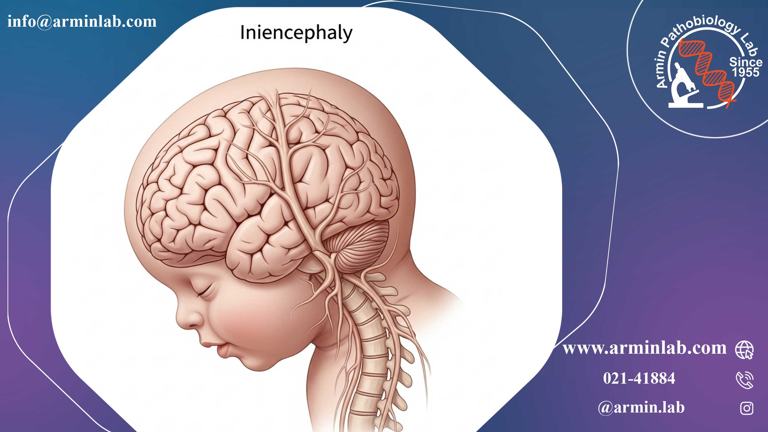 اینیِنسفالی یا نقص لوله عصبی