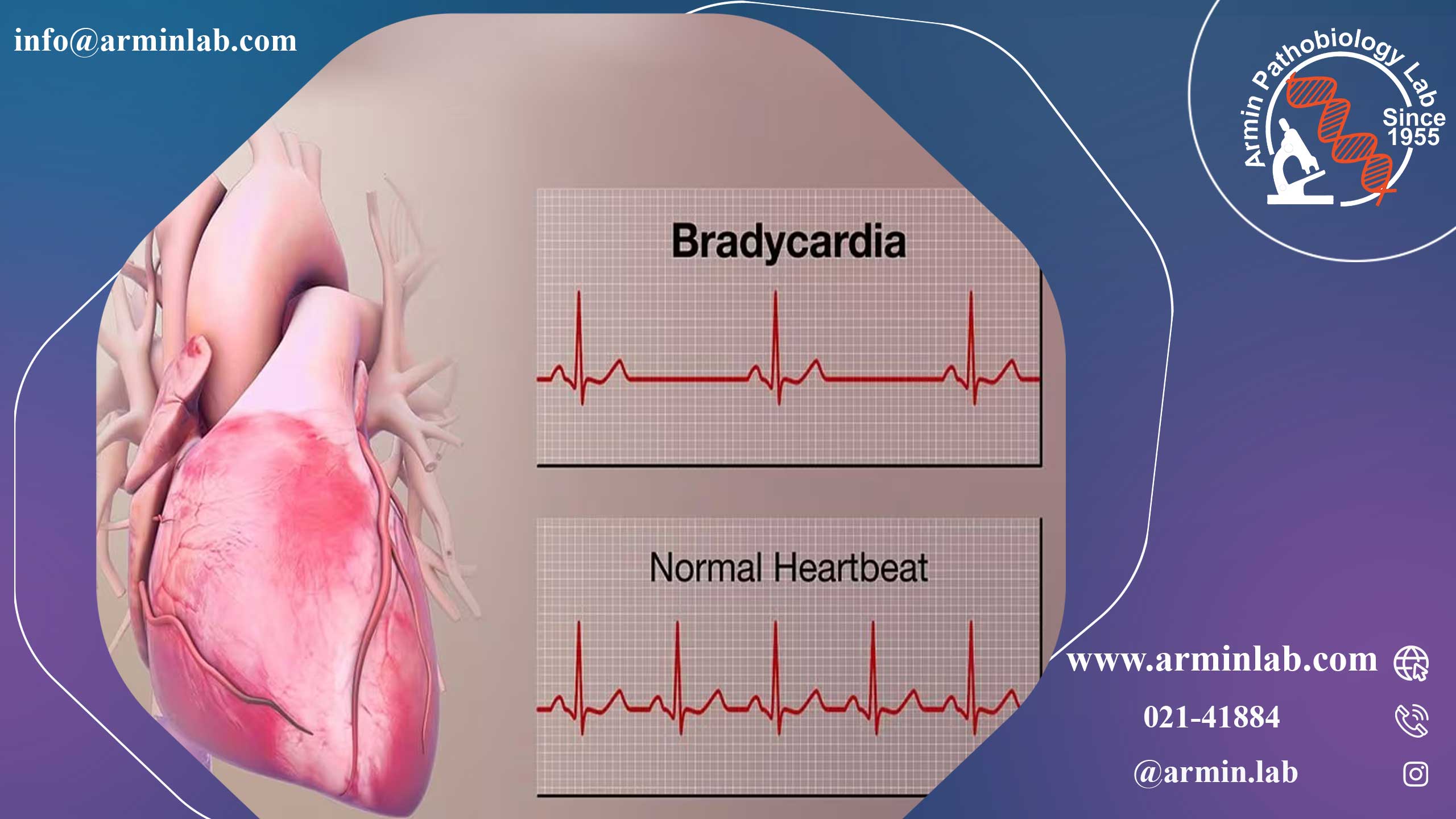 برادی کاردی (ضربان قلب آهسته)