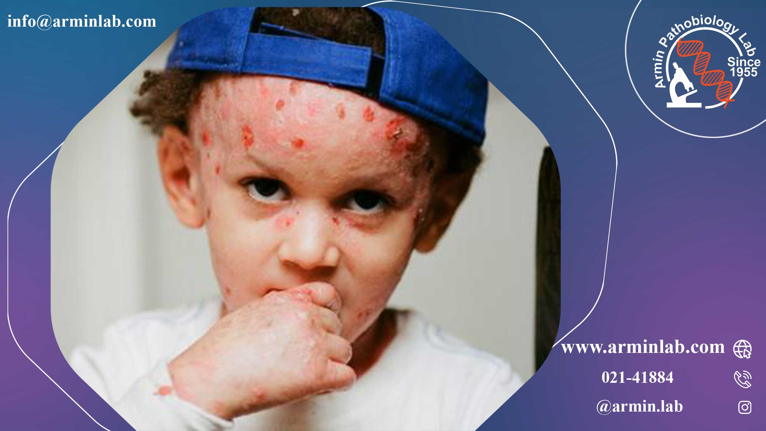 بیماری پروانه‌ای(Epidermolysis bullosa)